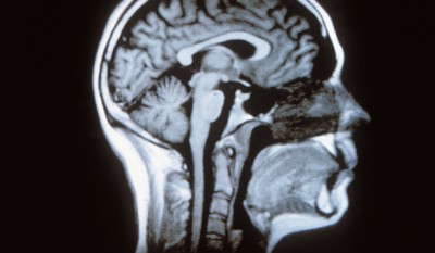 Cabanis, Emmanuel-Alain / Sagittal section of the human brain © ICM