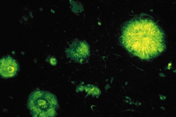 Plaques séniles, ou plaques amyloïdes, observées en fluorescence dans un cas de maladie d’Alzheimer © Inserm/U837