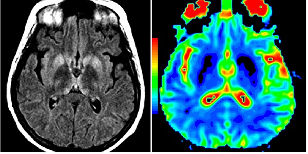 Brain MRI of a patient with the Creutzfeldt-Jakob disease
