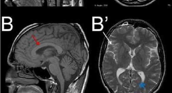 Bottom line, from left to right : atrophy of the corpus callosum and of the cerebellum, abnormal structures  of the mitochondrial network.