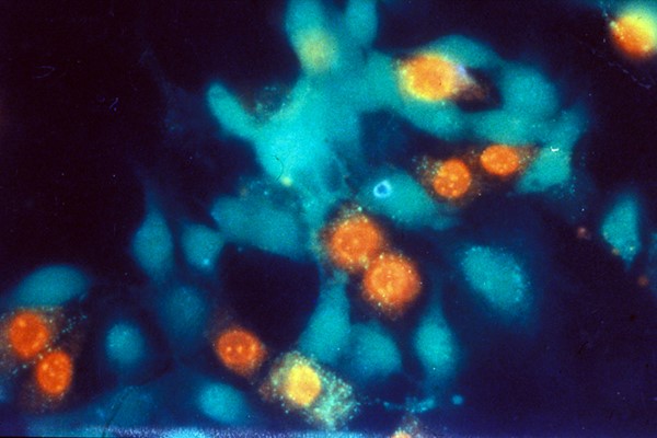 Sclérose en plaques, les cellules en rouge sont en train de mourir (mort cellulaire). Astrocytes exposés au facteur glycotoxique. © Inserm/RIEGER