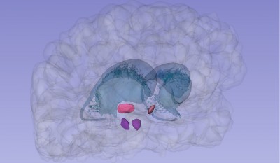 Image 3D des noyaux subthalamique et pédonculopontin