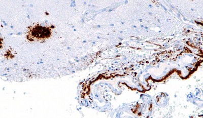 Photo : Cerebral amyloid angiopathy