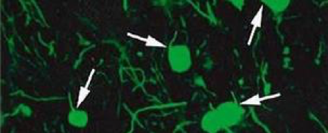 dégénérescence neuronale sclérose en plaques