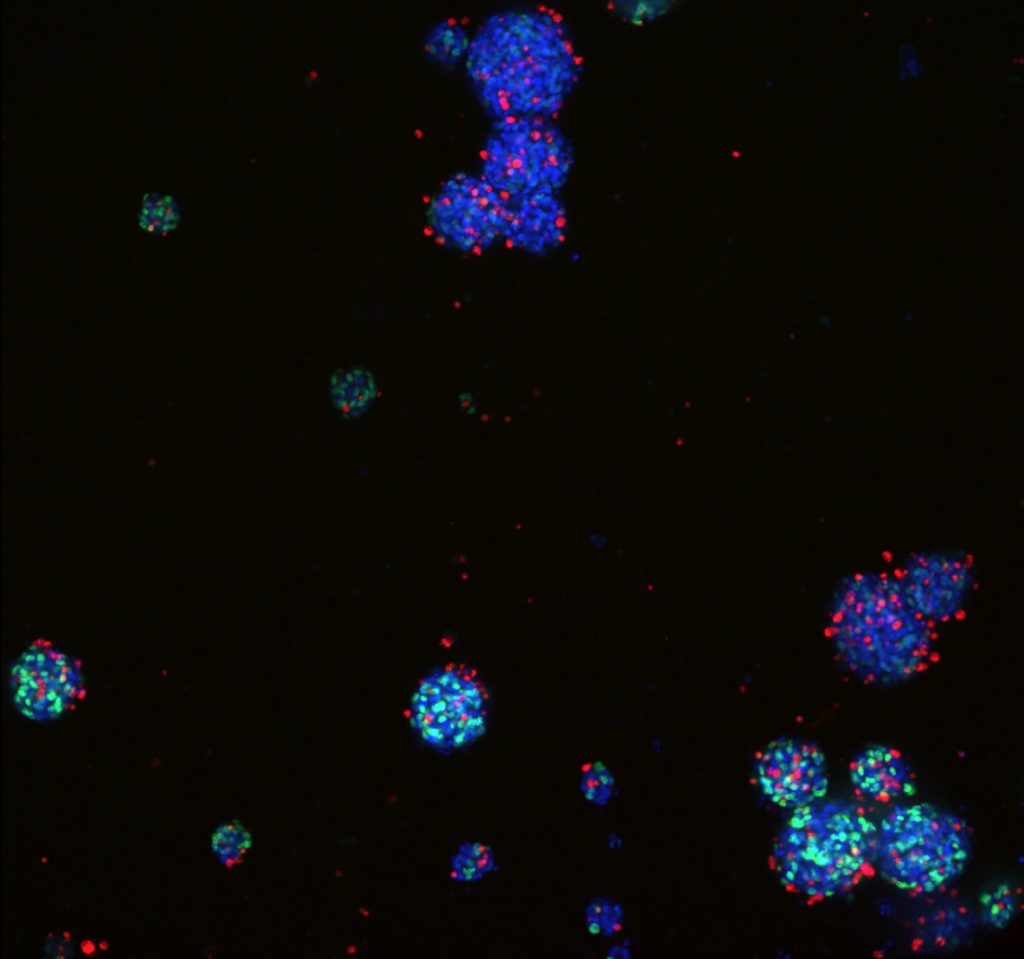 Gliome malin en culture cellulaire (spheroides). Les noyaux cellulaires sont marqués en bleus, les cellules répliquant leur ADN sont marquées en vert. Image 20X, microscope confocal ImageXpress Micro (crédit : Mehdi Touat, Caitlin Mills, HMS)