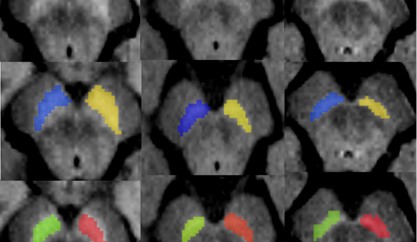 Images sensibles à la neuromélanine des régions d'intérêt de la substantia nigra pars compacta (SN) d'un volontaire sain dans la première colonne, d'un patient atteint d’un trouble isolé du comportement en sommeil paradoxal (iRBD) au milieu et d'un patient atteint de la maladie de Parkinson (PD) à droite. La première rangée montre les images sans les régions d'intérêt, la deuxième rangée montre les régions d'intérêt des mêmes sujets en utilisant la segmentation automatique et la dernière rangée montre les mêmes sujets en utilisant la segmentation manuelle.