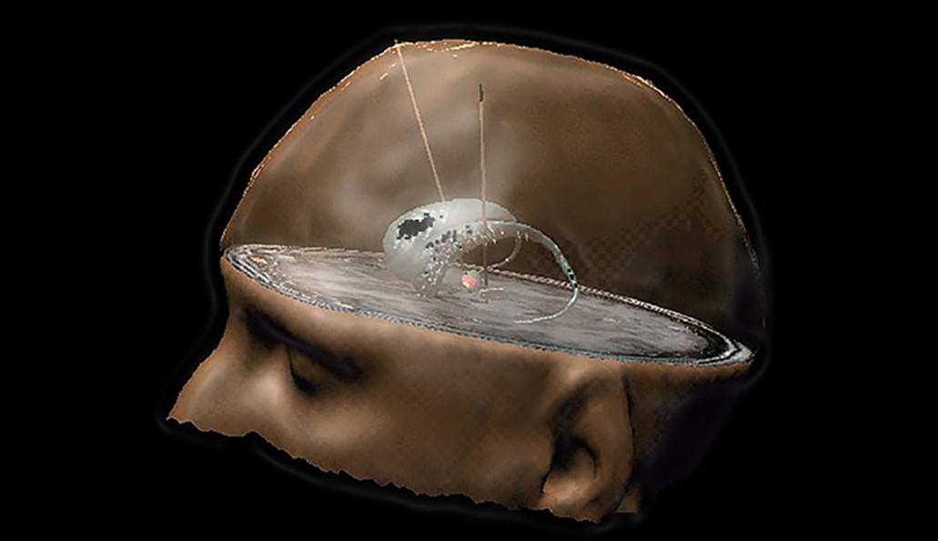 Visualisation des ganglions de la base et des électrodes de stimulation cérébrale profonde