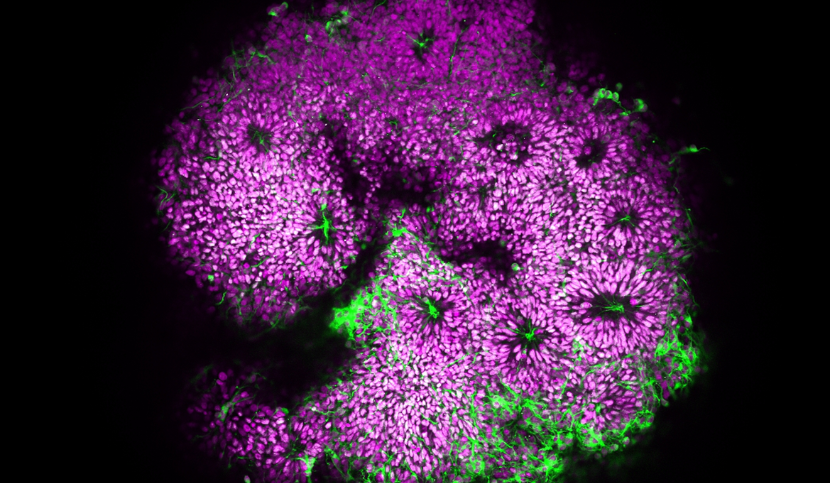 Organoïde de cortex humain. Les cellules progénitrices corticales apparaissent en blanc, et les nouveaux neurones en vert. Les autres cellules sont marquées en magenta en arrière-plan. Crédit : Khadijeh Shabani, Julien Pigeon, Institut du Cerveau.